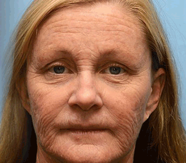 Crema Cleansing® para eliminar arrugas con veneno de abeja y botox (fabricada y enviada desde EE. UU.)